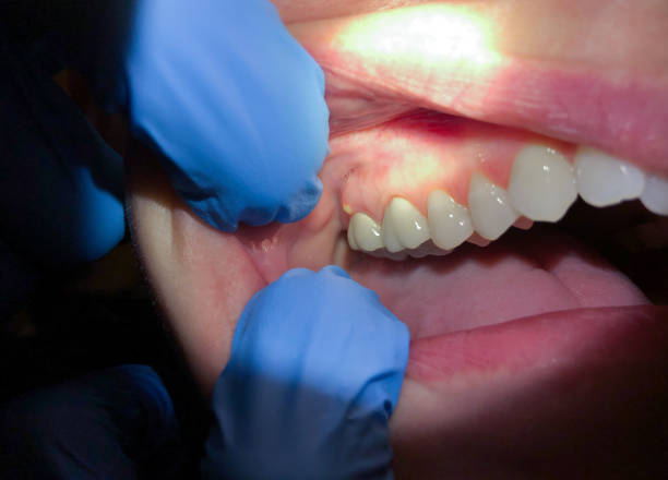 Best Emergency Wisdom Teeth Removal in Roselle Park, NJ