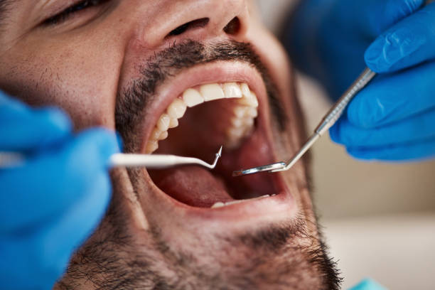 Best Emergency Dental Care for Broken or Chipped Teeth in Roselle Park, NJ